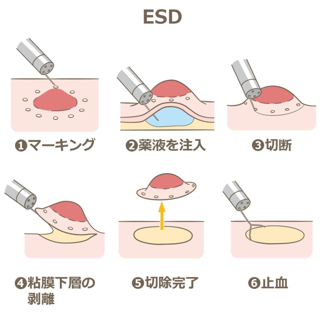 ESDの手順　①マーキング　②薬液を注入　③切断　④粘膜下層の剥離　⑤切除完了　⑥止血