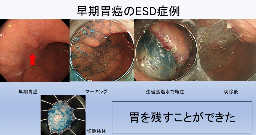 早期胃癌のESD症例　胃を残すことができた