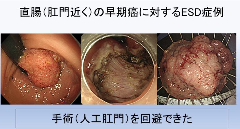 直腸（肛門近く）の早期癌に対するESD症例　手術（人工肛門）を回避できた