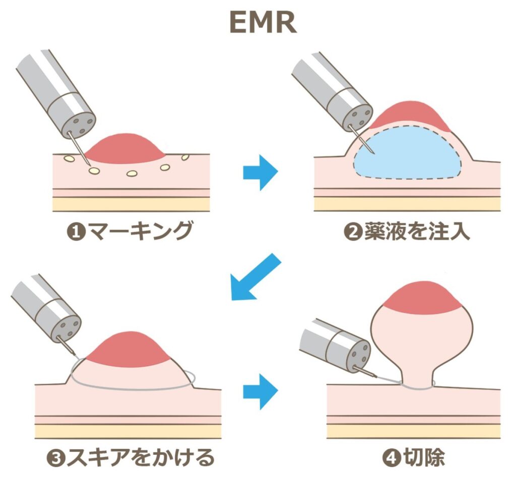 EMRの手順　①マーキング　②薬液を注入　③スキアをかける　④切除